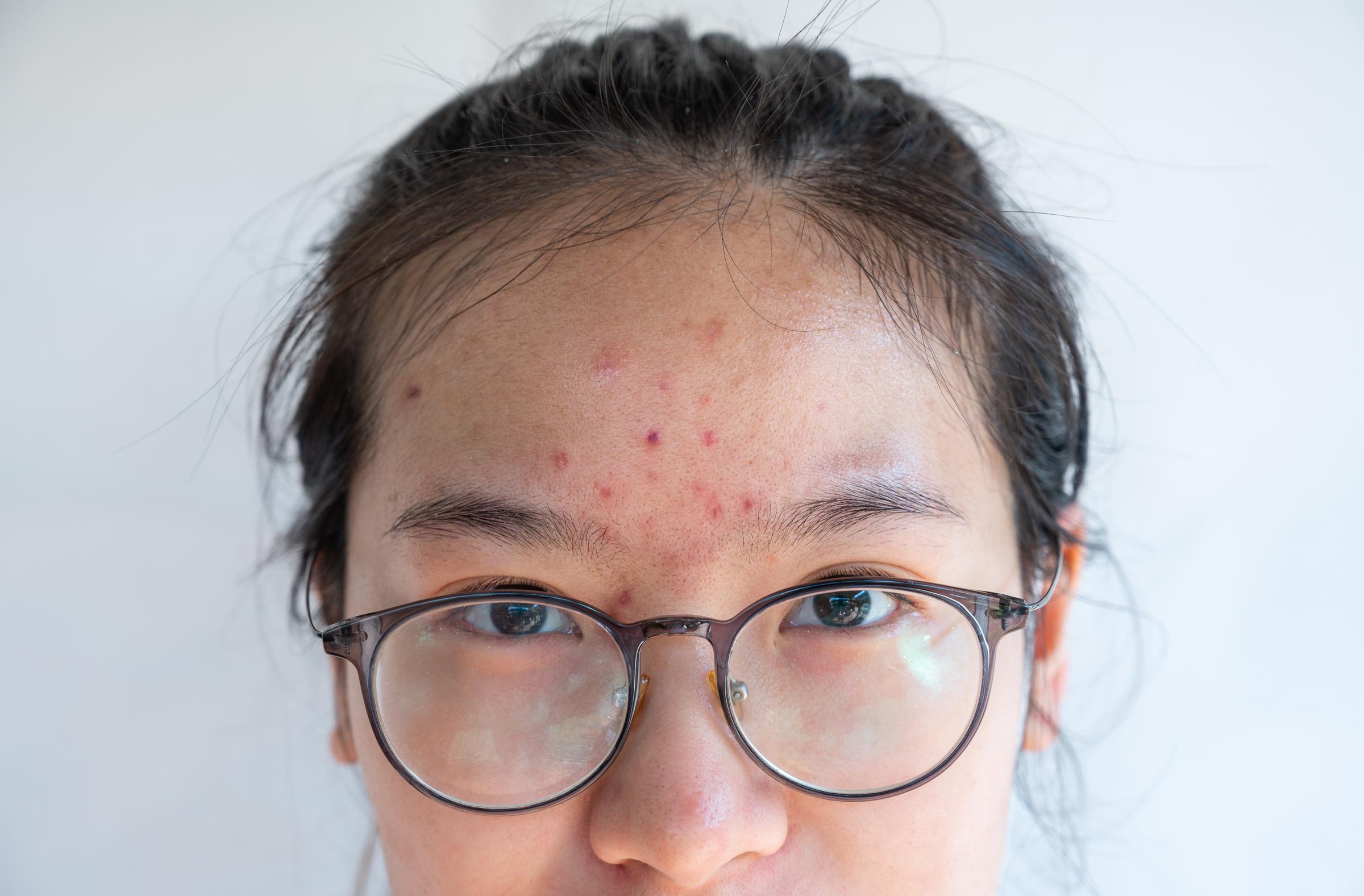 A woman with hormonal acne on her forehead | Source: Getty Images