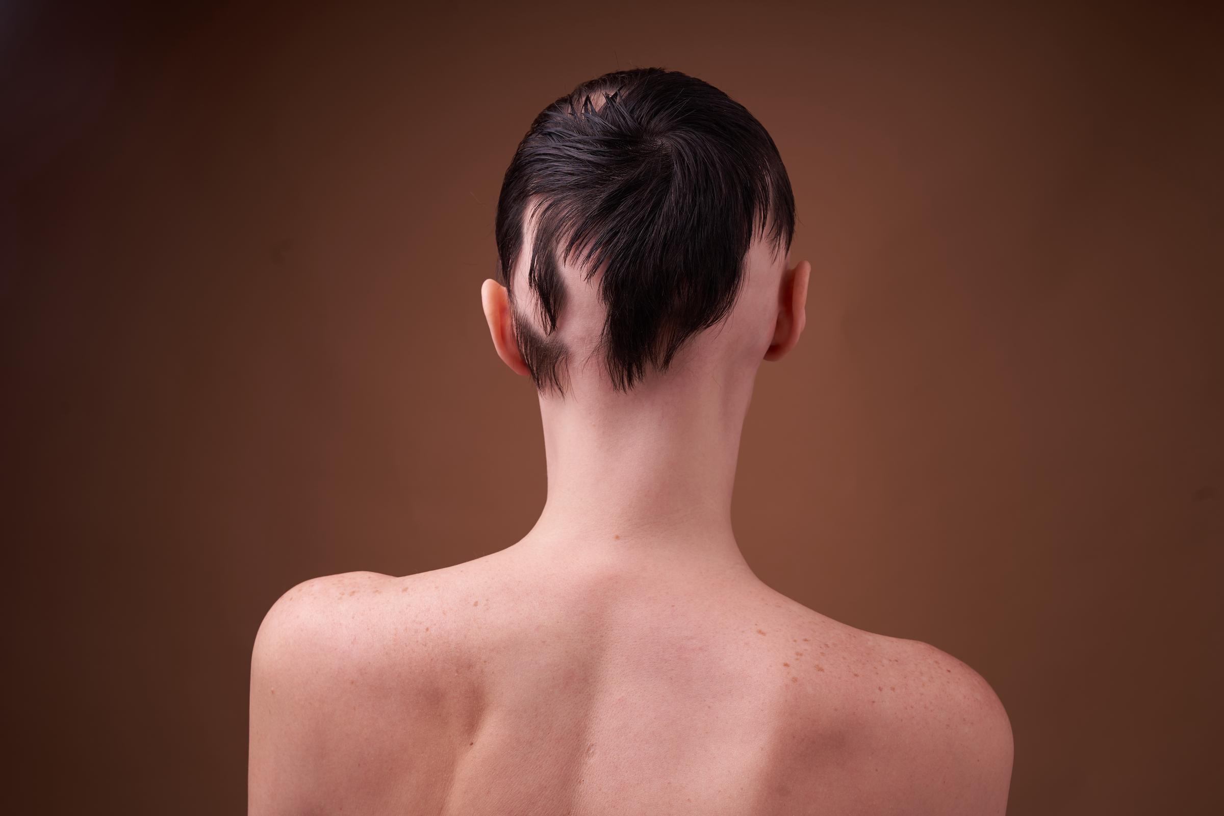 A woman suffering from alopecia | Source: Getty Images