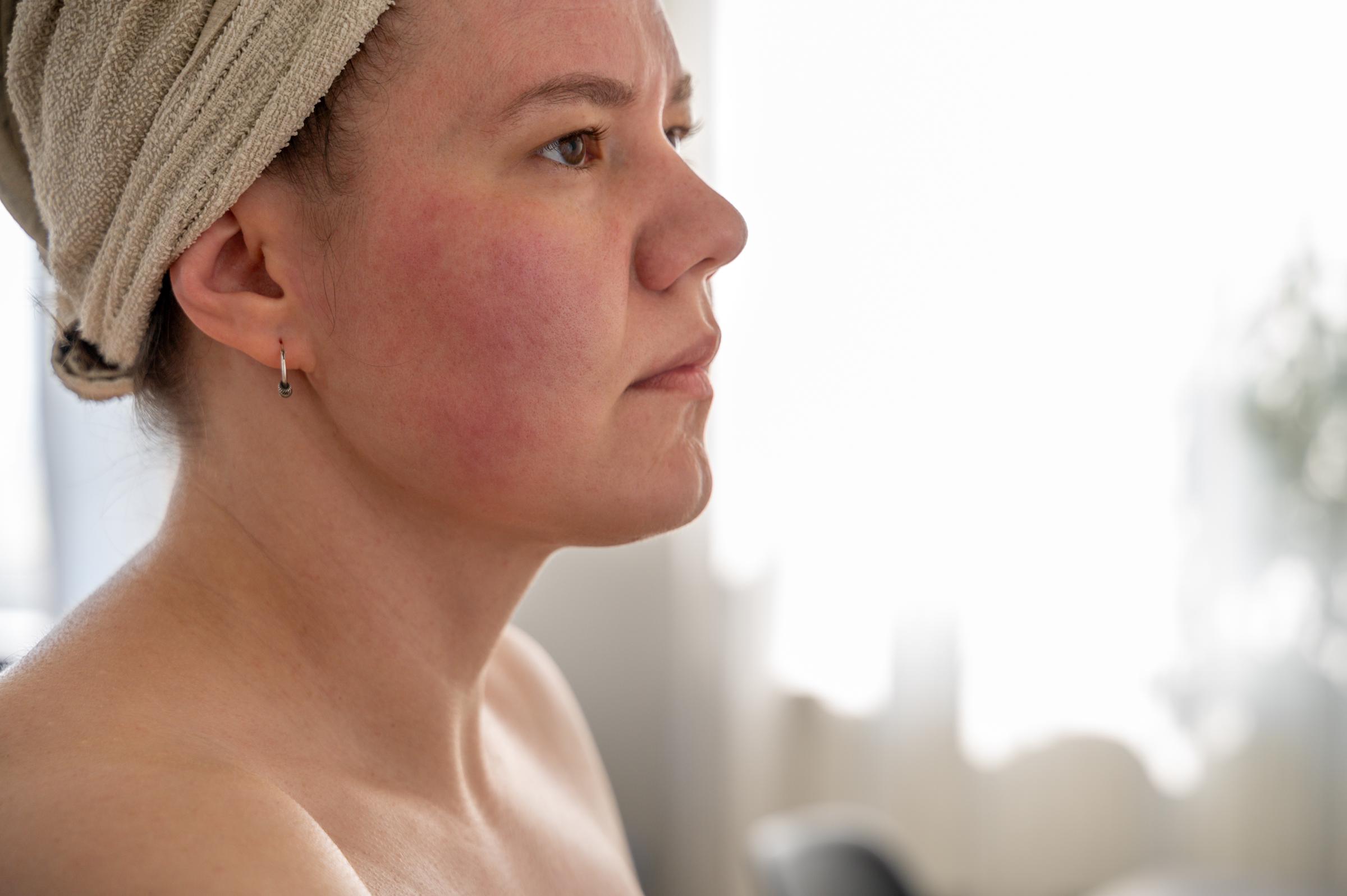 A woman noticing her skin is inflamed | Source: Getty Images