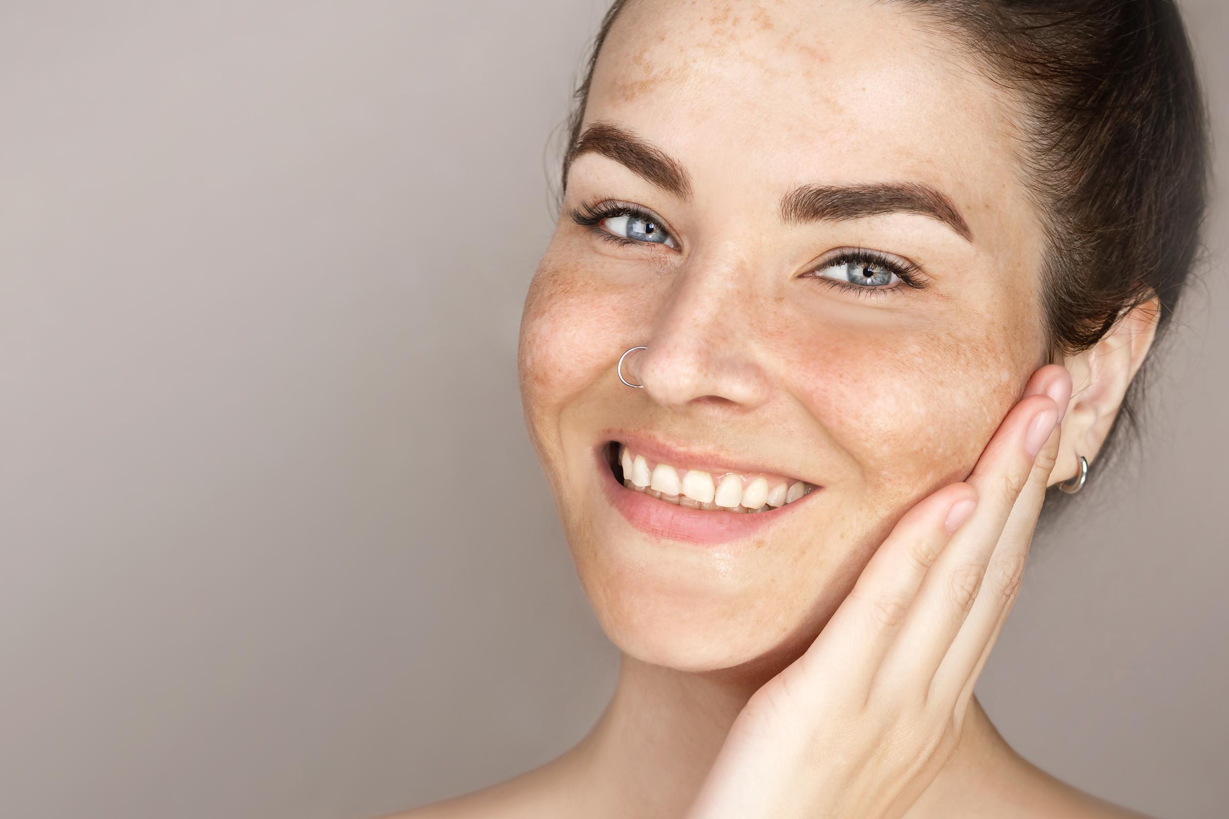 A young woman with age spots | Source: Getty Images