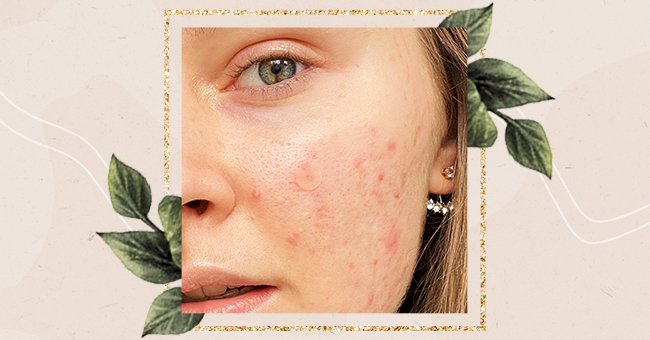 Vitamins That May Help Clear Acne