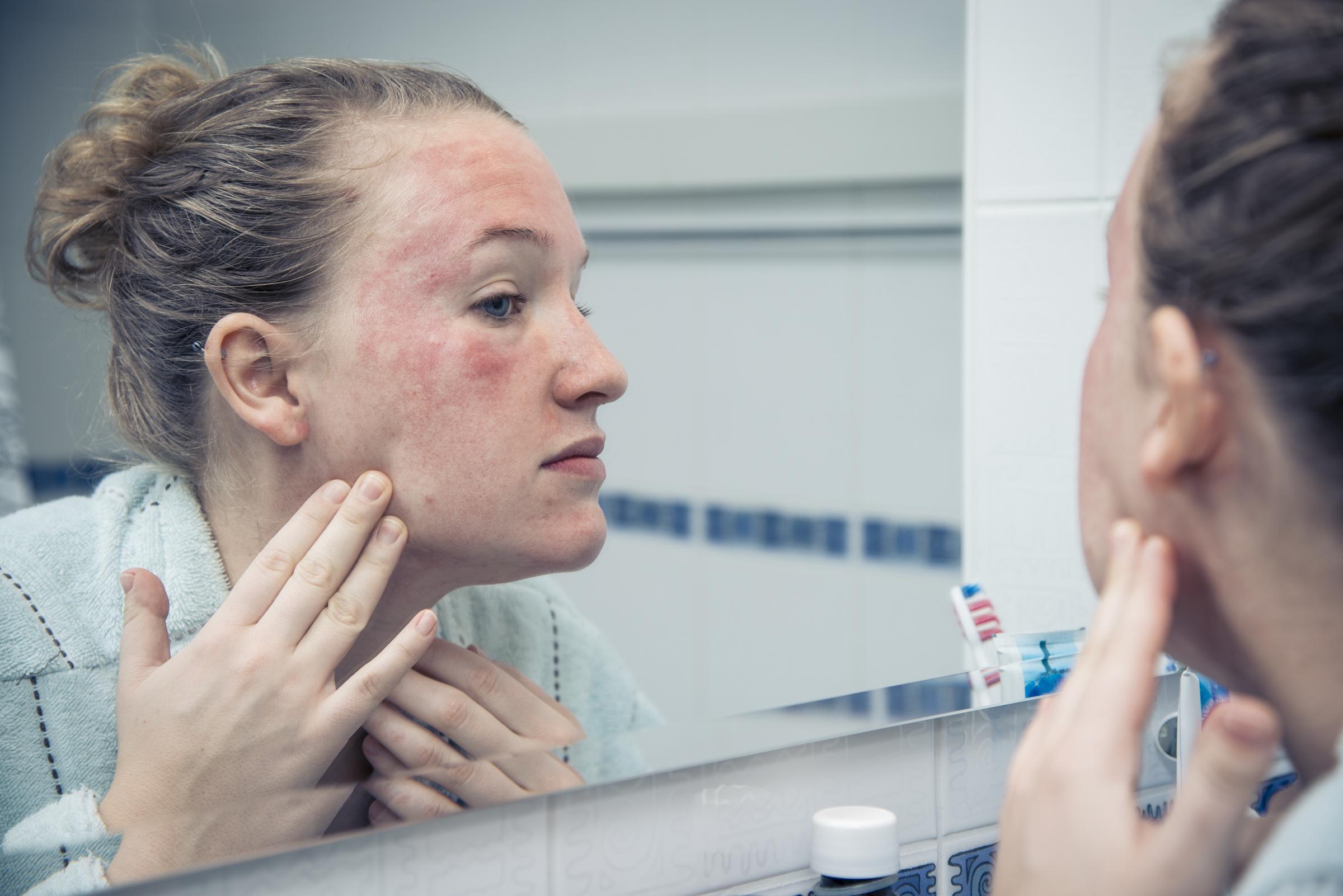 A woman with a serious skin reaction looking at herself in the mirror | Source: Getty Images