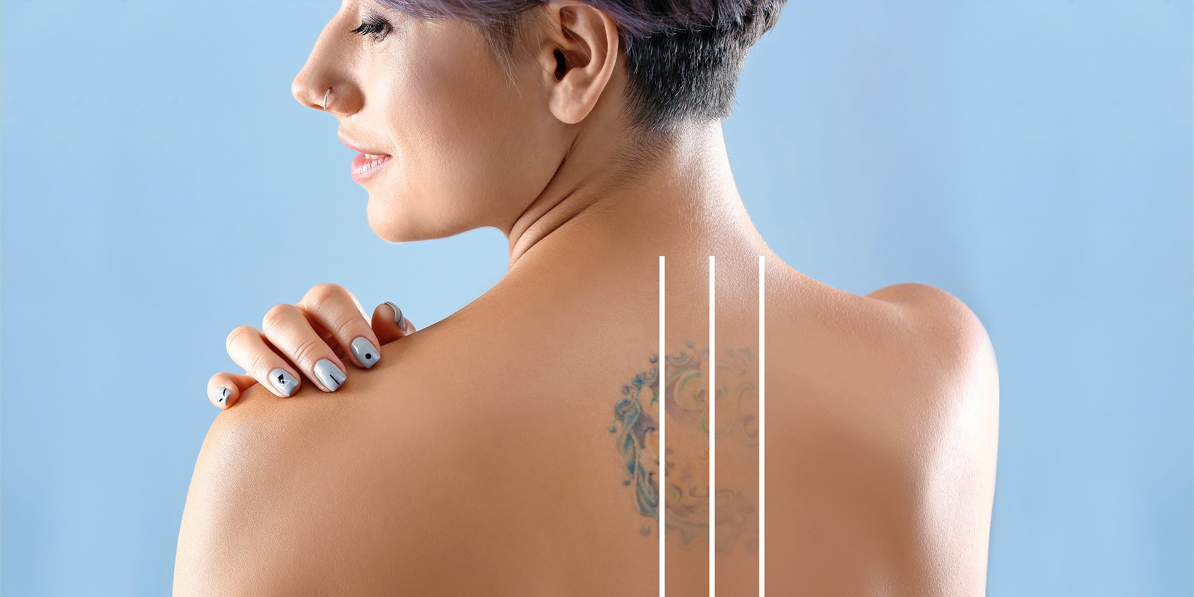 Tattoo removal. | Source:  Shutterstock.com