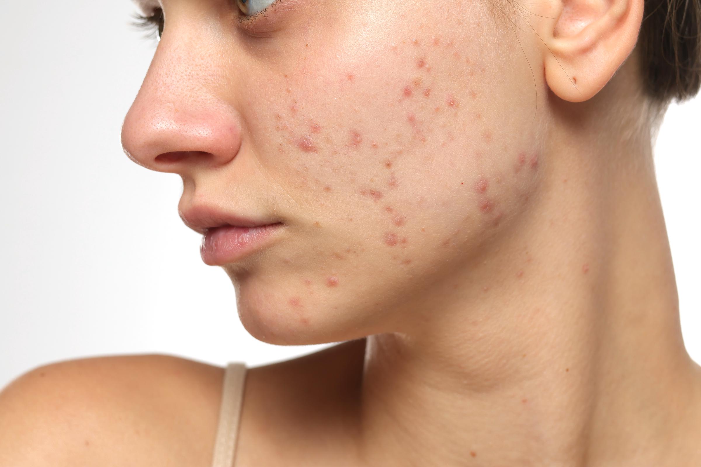 A young woman with acne | Source: Getty Images