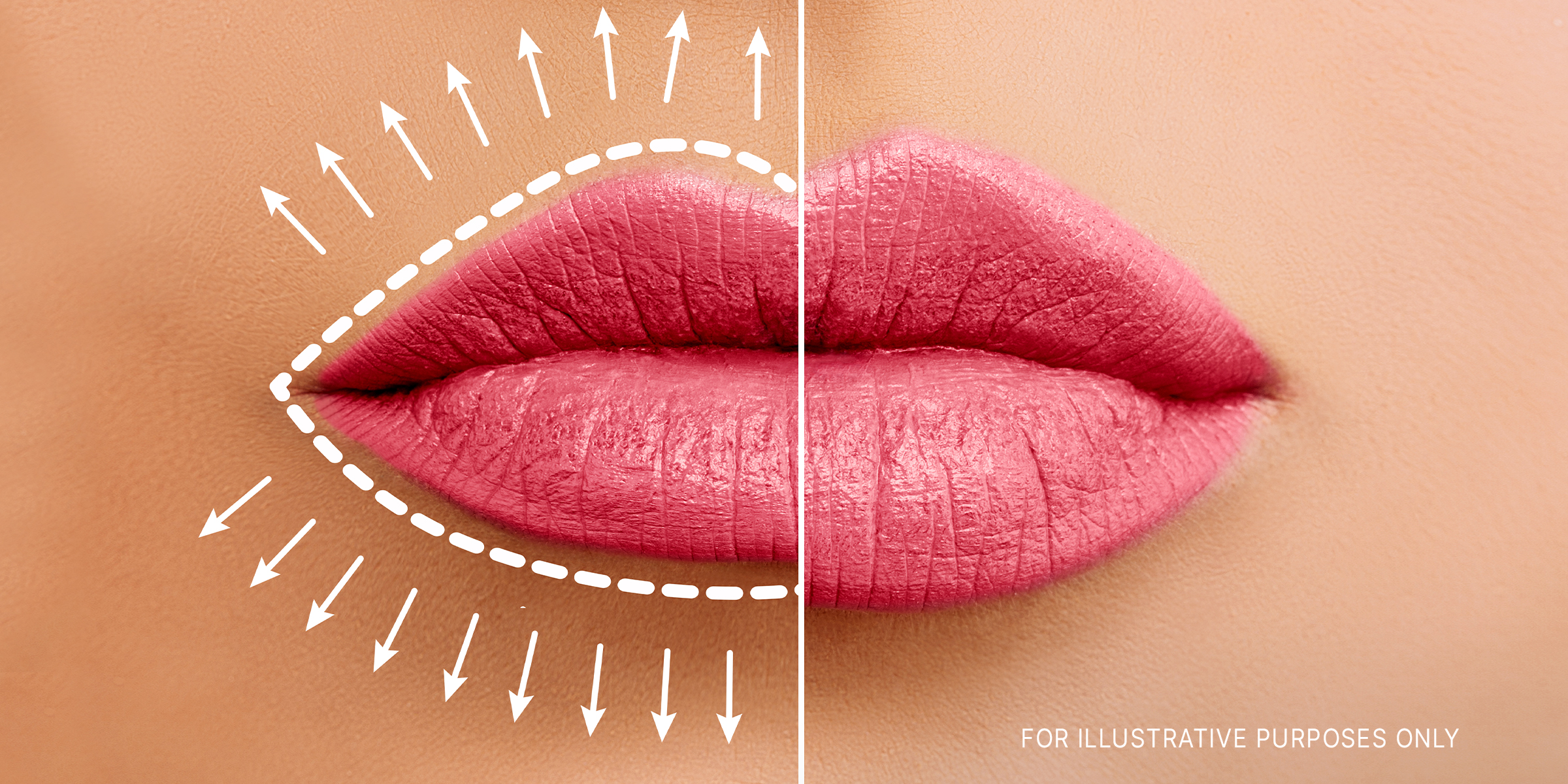 A before and after illustration of a lip flip. | Source: Shutterstock