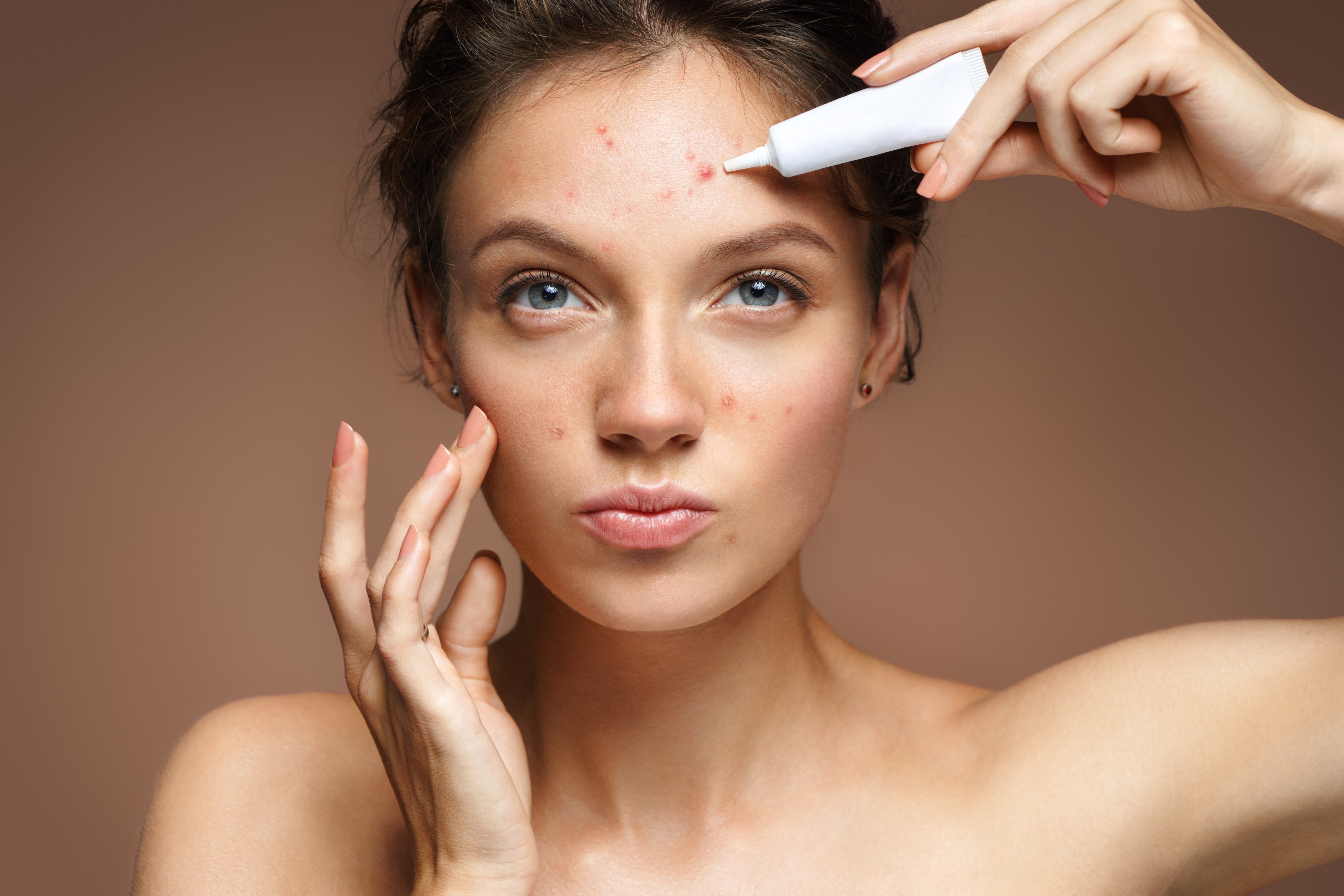 A woman treating her breakouts | Source: Shutterstock