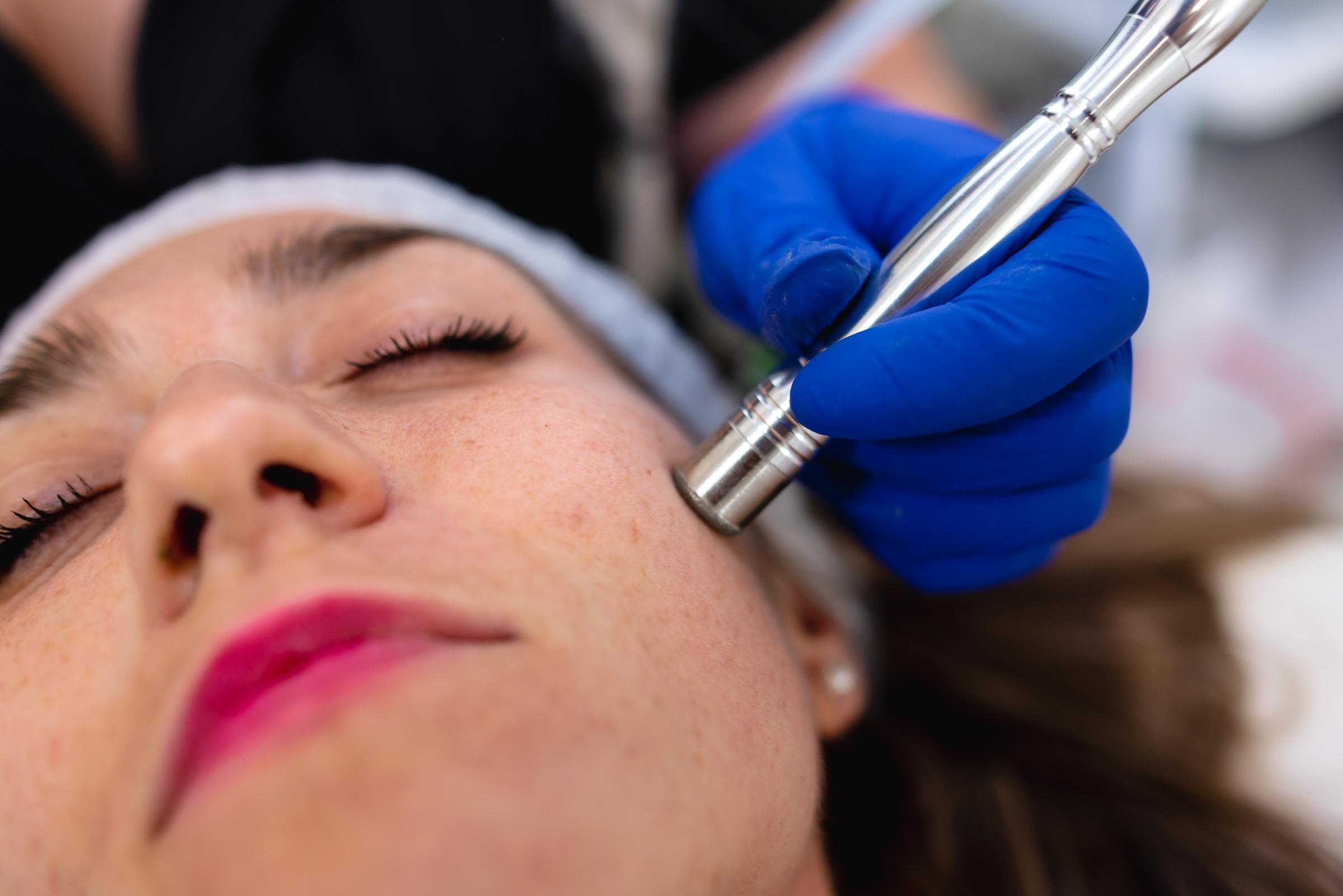 A woman undergoing a facial microdermabrasion procedure | Source: Getty Images